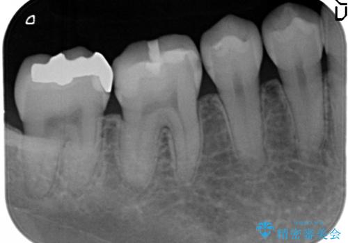 30代女性　歯と歯の間の虫歯に関する一例の治療前