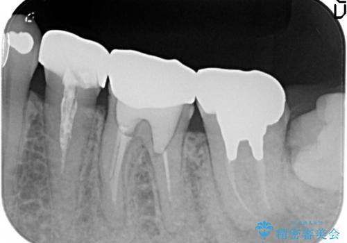 根管治療とインプラント治療により奥歯をしっかりとしたかみ合わせへの治療前