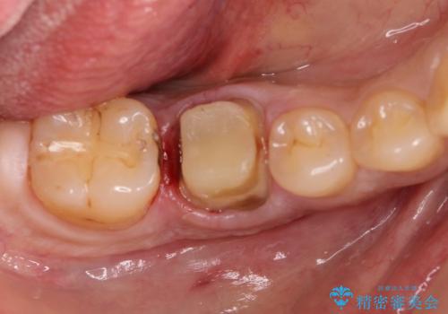 深いむし歯で型取りが困難な歯に適合のいい被せ物をの治療前