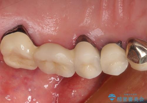 部分矯正で歯を正しい位置に移動しインプラント治療を行った症例の治療後
