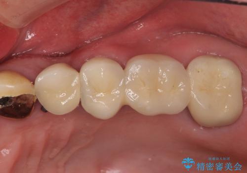 部分矯正で歯を正しい位置に移動しインプラント治療を行った症例の治療後
