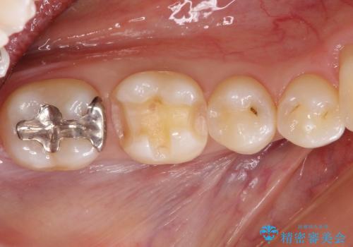 30代女性　歯と歯の間の虫歯に関する一例の治療中