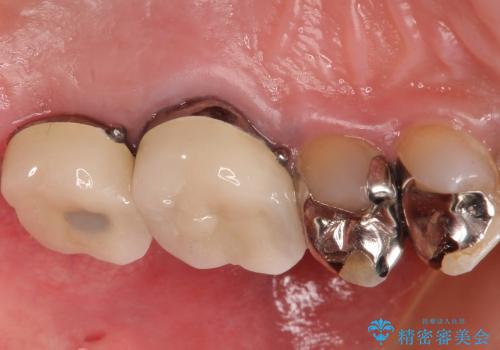 根管治療とインプラント治療により奥歯をしっかりとしたかみ合わせへの治療後