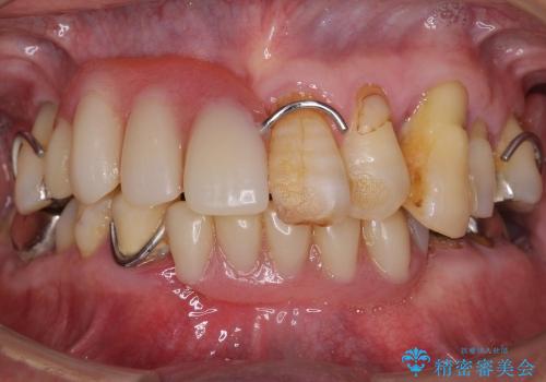 入れ歯のつくりかえ　部分入れ歯から総入れ歯へ　70代男性の治療中