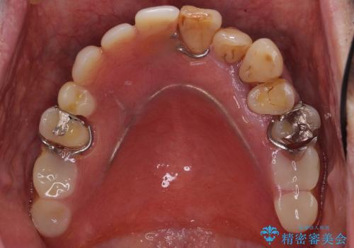 入れ歯のつくりかえ　部分入れ歯から総入れ歯へ　70代男性の治療中