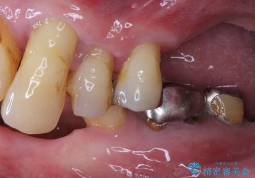 入れ歯のつくりかえ　部分入れ歯から総入れ歯へ　70代男性の治療前