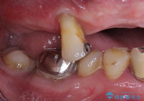入れ歯のつくりかえ　部分入れ歯から総入れ歯へ　70代男性の治療前