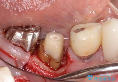 50代女性　奥歯が折れた→歯周外科・根管治療で再生の治療中