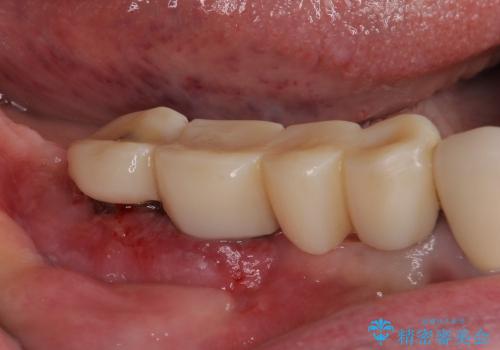インプラント周辺の丈夫な歯肉の獲得　(遊離歯肉移植術・FGG)の治療中