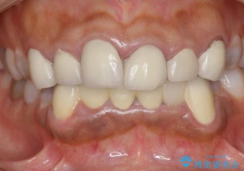 [テトラサイクリン歯]  前歯ラミネートからクラウンへのやりかえの治療前