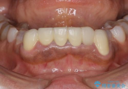 [テトラサイクリン歯]  前歯ラミネートからクラウンへのやりかえの治療前