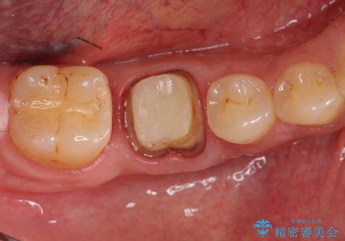 深いむし歯で型取りが困難な歯に適合のいい被せ物をの治療中