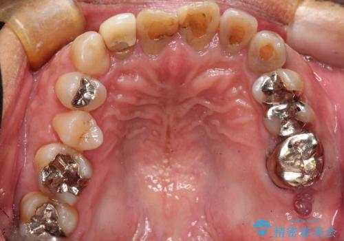 根管治療とインプラント治療により奥歯をしっかりとしたかみ合わせへの治療前