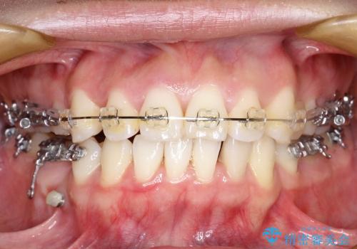 20代女性　矯正治療中に歯肉移植を行うことで歯肉退縮の予防を図った一例の治療前