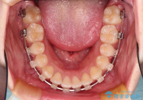 20代女性　抜歯矯正 ループメカニクス による前突感の改善の治療中