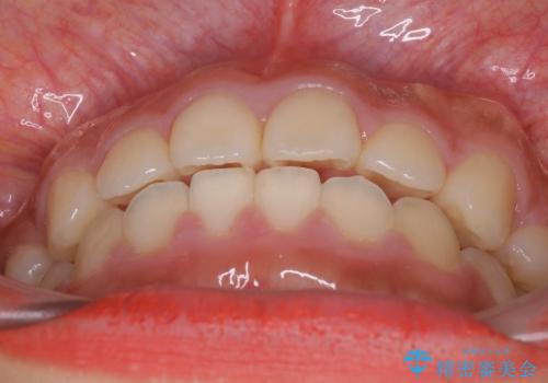 20代女性　抜歯矯正 ループメカニクス による前突感の改善の治療後