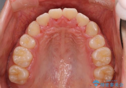 20代女性　抜歯矯正 ループメカニクス による前突感の改善の治療後