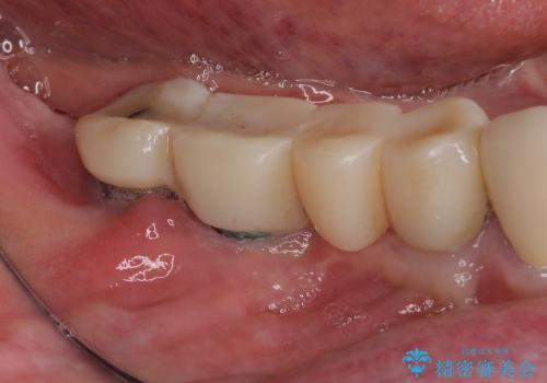 インプラント周辺の丈夫な歯肉の獲得　(遊離歯肉移植術・FGG)の治療前