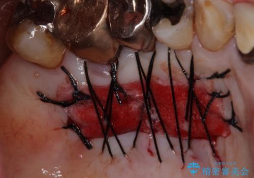インプラント周辺の丈夫な歯肉の獲得　(遊離歯肉移植術・FGG)の治療中