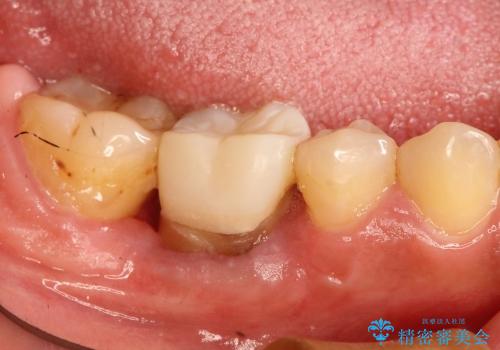 深いむし歯で型取りが困難な歯に適合のいい被せ物をの治療中