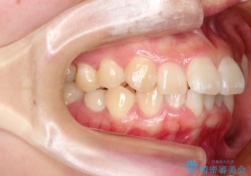 出っ歯を治したい　メタル装置による抜歯矯正