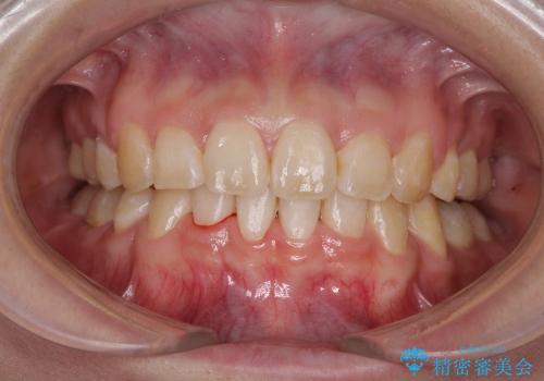出っ歯を治したい　メタル装置による抜歯矯正の治療後