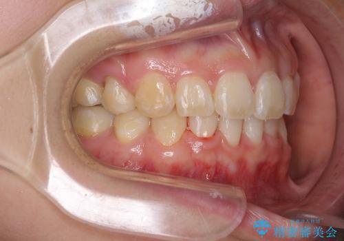 出っ歯を治したい　メタル装置による抜歯矯正の治療後