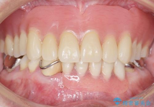 入れ歯のつくりかえ　部分入れ歯から総入れ歯へ　70代男性の治療後