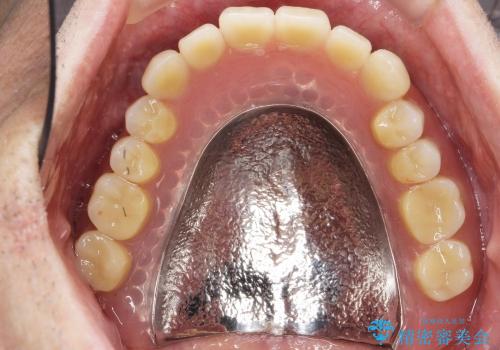 入れ歯のつくりかえ　部分入れ歯から総入れ歯へ　70代男性の治療後