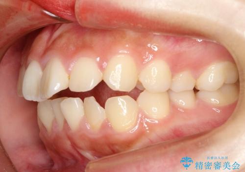 20代女性　抜歯矯正 ループメカニクス による前突感の改善の治療前