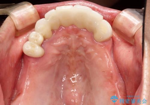 [インプラント支台義歯] マグネットアタッチメントを用いた噛める入れ歯の治療前
