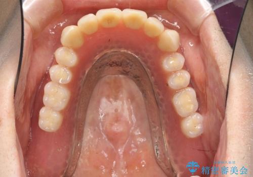 [インプラント支台義歯] マグネットアタッチメントを用いた噛める入れ歯の治療後