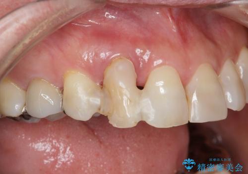 [前歯部ブリッジ治療①]  埋伏歯の抜歯ー歯ぐきの移植による顎堤増大の治療前