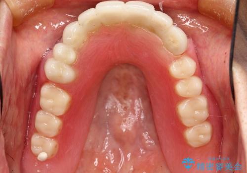 [インプラント支台義歯] マグネットアタッチメントを用いた噛める入れ歯の治療中