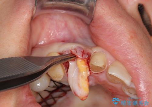 [前歯部ブリッジ治療①]  埋伏歯の抜歯ー歯ぐきの移植による顎堤増大の治療後