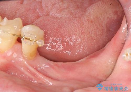 [骨造成を伴うインプラント治療②] インプラントの2次手術(歯肉移植)〜最終補綴の治療前