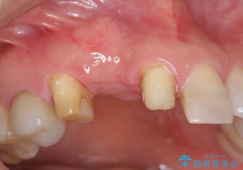[前歯部ブリッジ治療①]  埋伏歯の抜歯ー歯ぐきの移植による顎堤増大の治療中