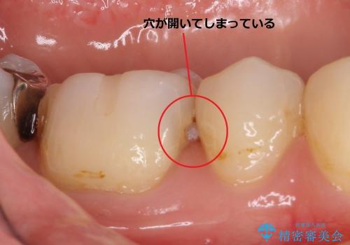 30代女性　歯と歯の間の虫歯に関する一例の治療前