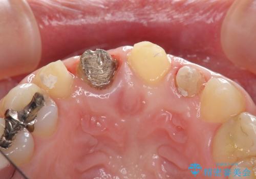 [歯ぐきの環境を整えてからの前歯の審美治療 ①] クラウンの除去 - 仮歯の作製 - 歯周外科手術の治療中