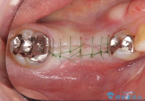 [乳歯の晩期残存]  残せない乳歯のインプラントによる咬合回復の治療中