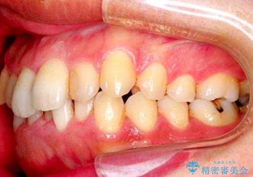 30代男性 フルリンガルによるガタつき八重歯の改善の治療前