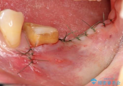 [ 大臼歯部骨造成・インプラント治療① ] 骨造成 ー インプラント埋入の治療中