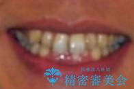 30代男性 フルリンガルによるガタつき八重歯の改善の治療前（顔貌）
