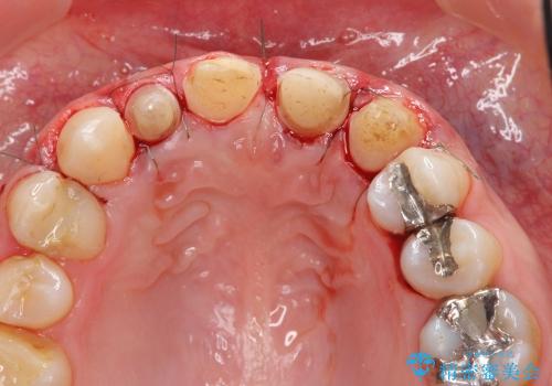 [歯ぐきの環境を整えてからの前歯の審美治療 ②]  歯周外科手術治癒後のセラミッククラウン作製の治療前