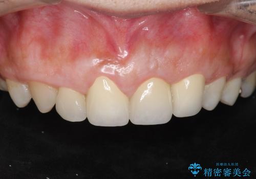 [歯ぐきの環境を整えてからの前歯の審美治療 ①] クラウンの除去 - 仮歯の作製 - 歯周外科手術の治療前