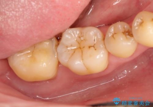 保存不可能な歯の抜歯後のインプラント治療の治療前
