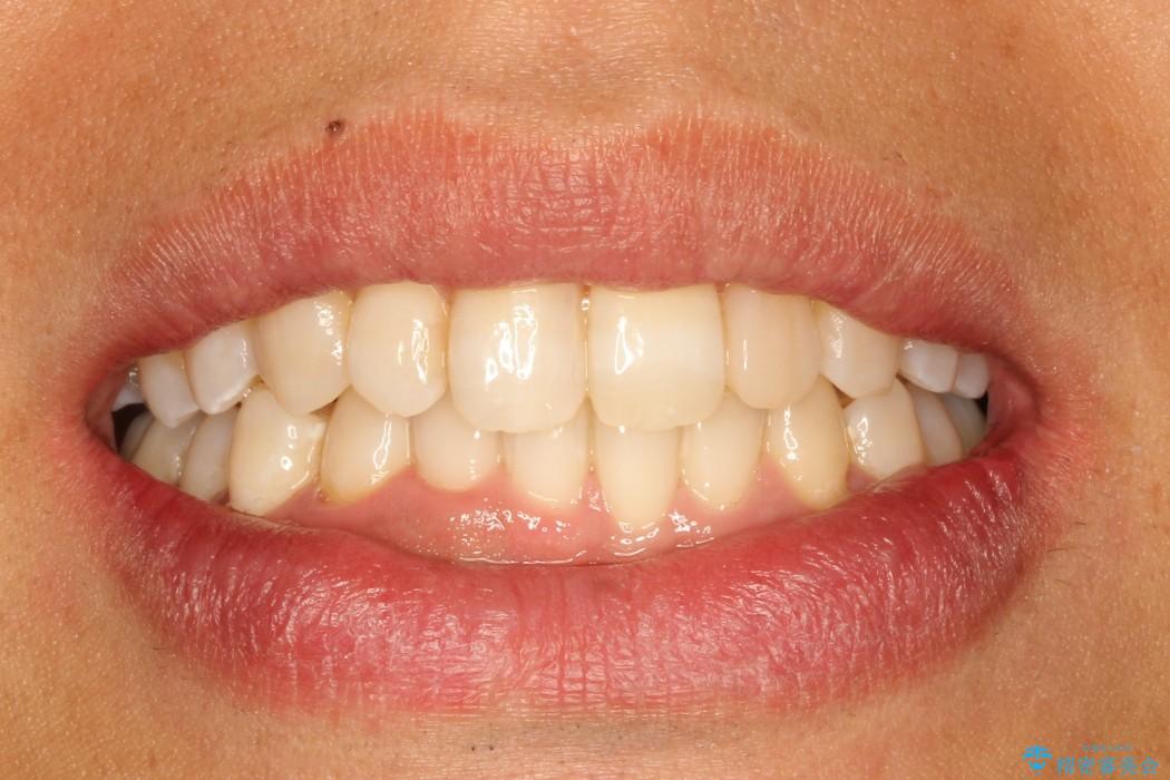 30代男性 フルリンガルによるガタつき八重歯の改善の治療後（顔貌）