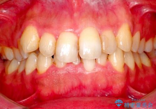 30代男性 フルリンガルによるガタつき八重歯の改善の治療前