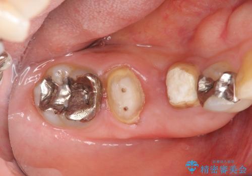 [乳歯の晩期残存]  残せない乳歯のインプラントによる咬合回復の治療前
