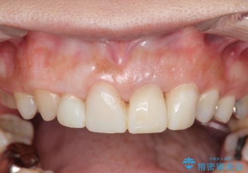 [歯ぐきの環境を整えてからの前歯の審美治療 ①] クラウンの除去 - 仮歯の作製 - 歯周外科手術の治療中